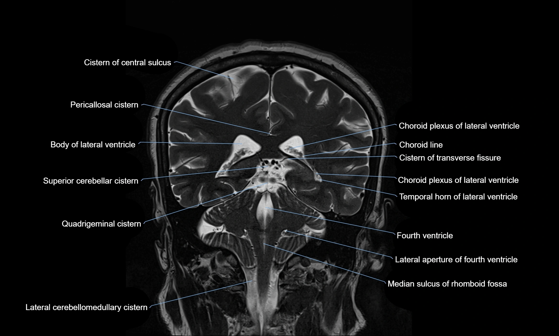 Brain cisterns  and ventricles coronal anatomy 3T MRI image-img-00001-00039.webp